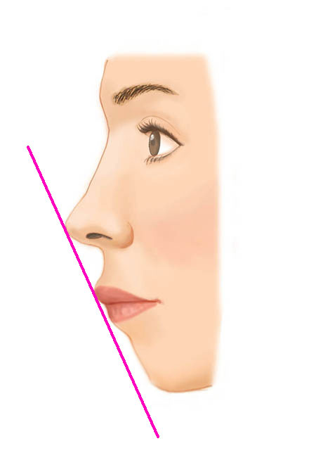 口角挙上（スマイルリップ）After