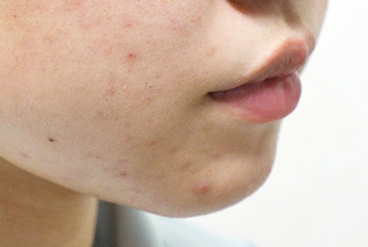 症例2　ヒアルロン酸注射（あご） 施術前