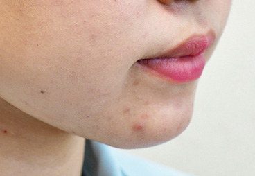 症例2　ヒアルロン酸注射（あご） 施術後