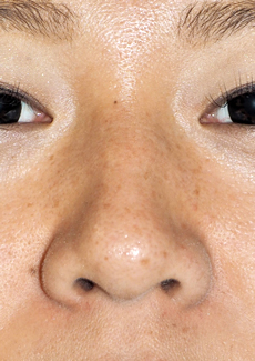 症例2　鼻ヒアルロン酸（隆鼻） 施術前
