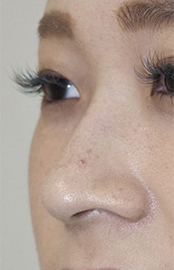 症例3　鼻ヒアルロン酸（隆鼻） 施術前