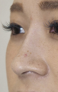 症例3　鼻ヒアルロン酸（隆鼻） 施術後