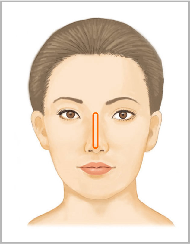 鼻ヒアルロン酸