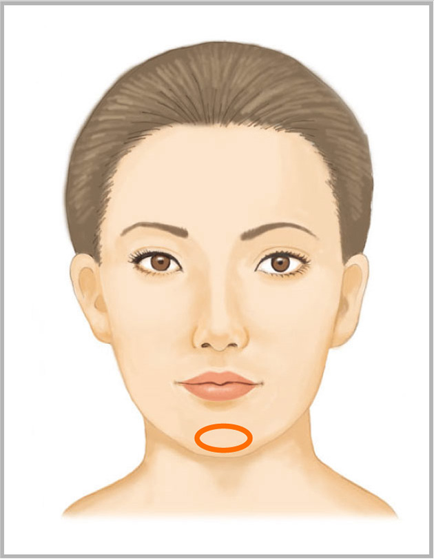 あごヒアルロン酸