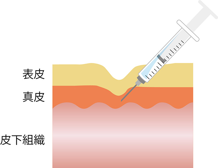 ヒアルロン酸注射とは ヒアルロン酸の真皮への注入