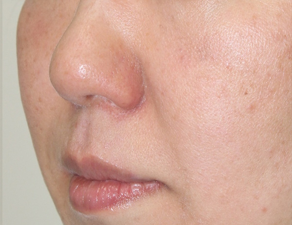症例2　鼻翼基部ヒアルロン酸注射（貴族注射） 施術後