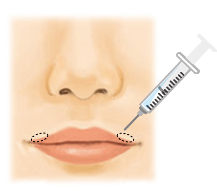 口角挙上（スマイルリップ）Before