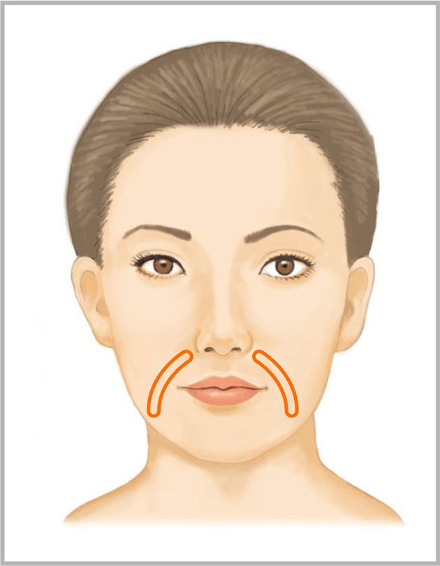 法令線へのヒアルロン酸注射