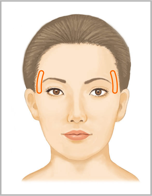 おでこ（額）、こめかみをふっくらとさせるヒアルロン酸