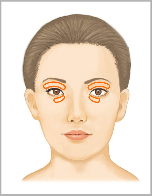 上まぶた、下まぶたのくぼみへのヒアルロン酸