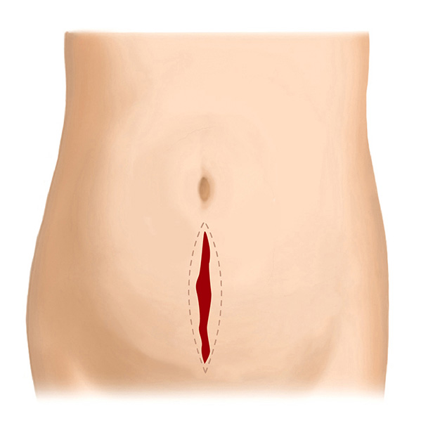 帝王切開後の傷跡修正（縦） Before