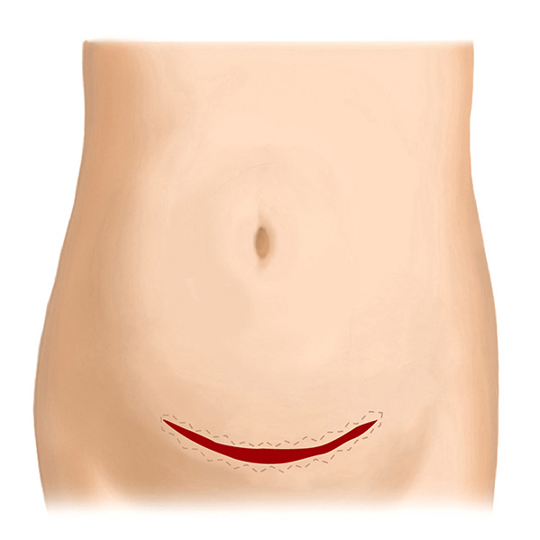 帝王切開後の傷跡（横）～W形成術の応用～ Before