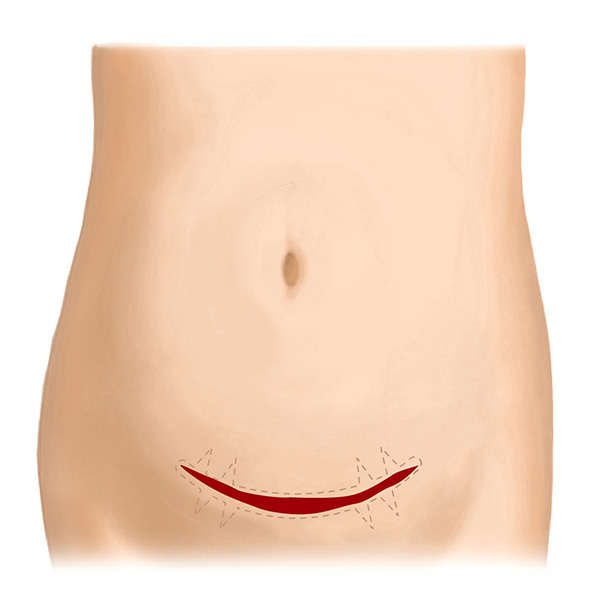 帝王切開後の傷跡（横）～Z形成術の応用～ Before