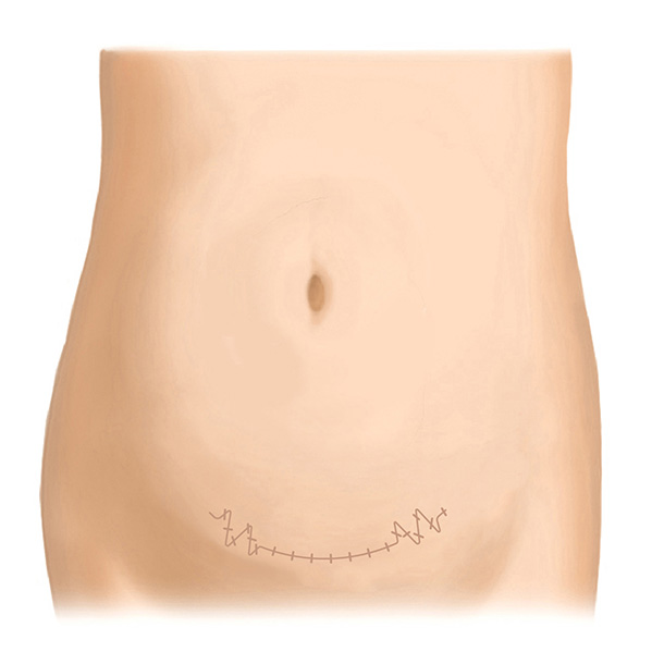 帝王切開後の傷跡（横）～Z形成術の応用～ After