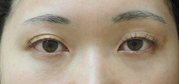 症例10　クマ取り（結膜側脱脂術） 手術後
