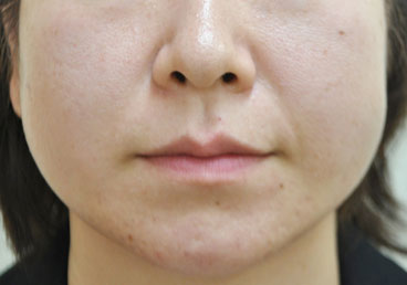症例1　脂肪溶解注射とボトックス（えら） 治療前