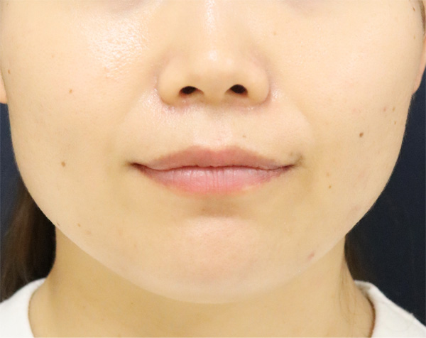 症例2　脂肪溶解注射とえら（小顔）ボトックス 治療前