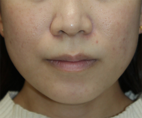 症例9　ニキビ（ケミカルピーリング） 治療後6か月