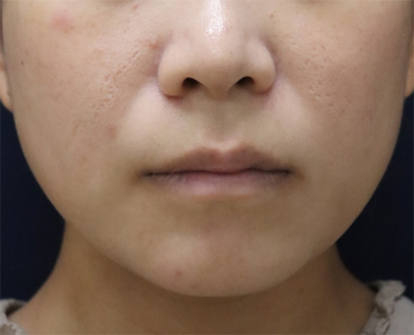症例9　ニキビ（ケミカルピーリング） 治療後1年