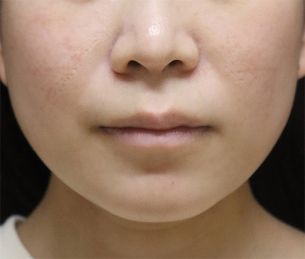 症例5　ニキビ、ニキビ跡（フォトフェイシャル、ダーマペン） ニキビ跡治療後
