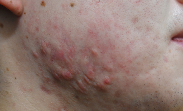 症例6　ニキビ跡（ケナコルト注射） 治療前