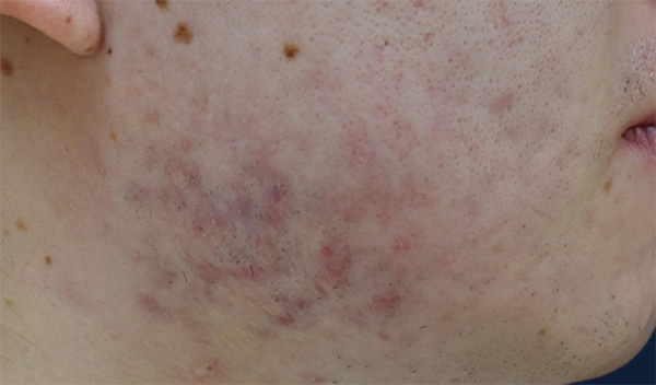 症例6　ニキビ跡（ケナコルト注射） 治療後