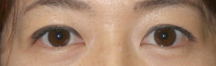 症例6　上まぶたのたるみ手術＋眼瞼下垂 手術後