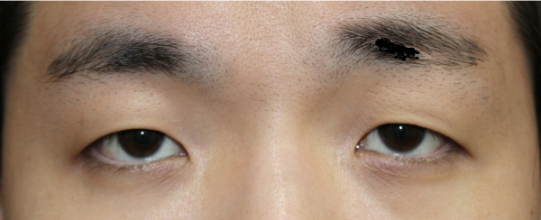 症例10　二重まぶた 切開法・眼瞼下垂 手術前