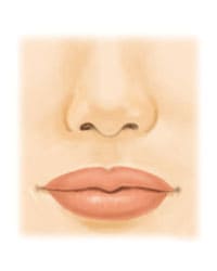口唇縮小術（たらこ唇を治す、唇を薄くする）1