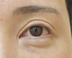 症例40　他院目頭切開術後 手術前
