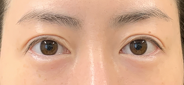 症例23　二重切開法の他院修正 手術前