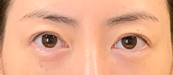 症例23　二重切開法の他院修正 手術後