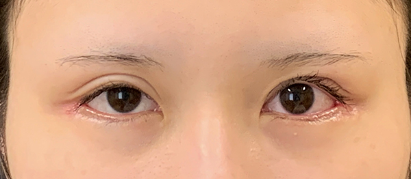 症例10　他院二重切開法術後 手術前