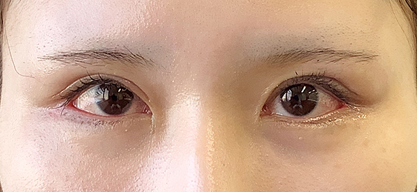 症例10　他院二重切開法術後 手術後