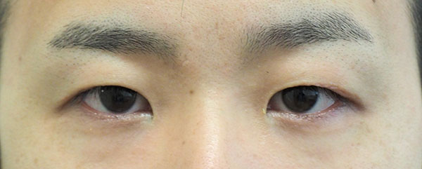 症例4　他院眼瞼下垂術後 手術後