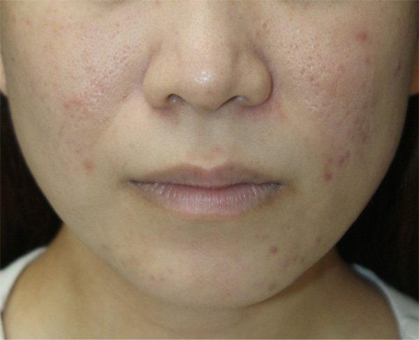 症例11　フォトフェイシャル（ニキビ跡）治療前