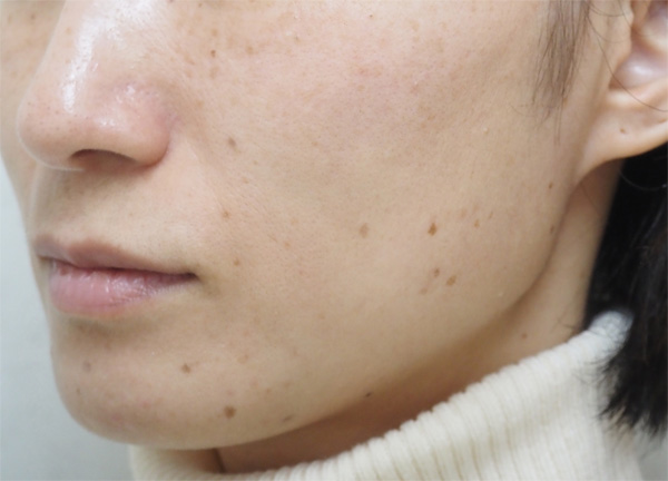 症例12　フォトフェイシャル（老人性色素斑）治療前