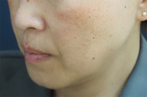 症例3　頬の肝斑、そばかす、老人性色素斑 治療前
