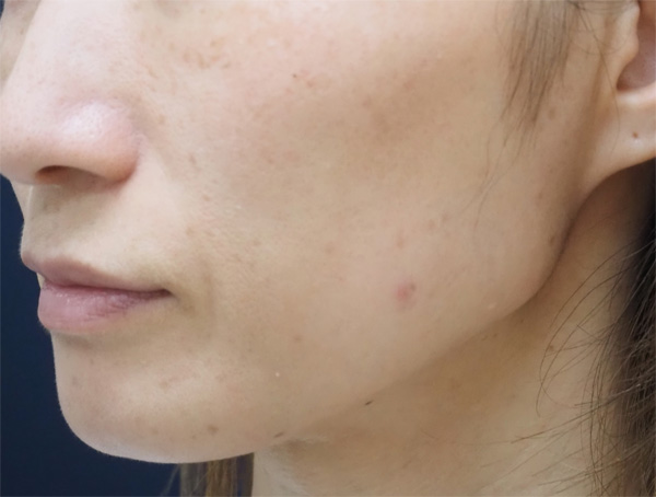 症例13　老人性色素斑（顔全体）フォトフェイシャル治療 治療後