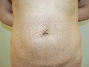 症例1　腹部の脂肪吸引＋腹壁形成術（タミータック手術） 手術前