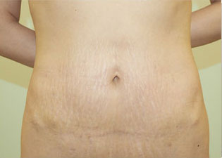 症例1　腹部の脂肪吸引＋腹壁形成術（タミータック手術） 手術後