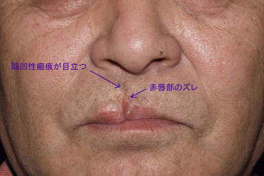 症例2　口唇裂術後修正手術 手術前