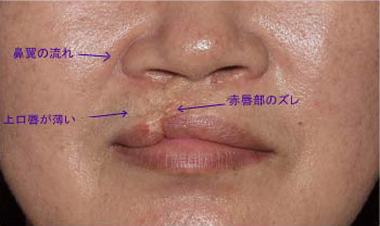 症例3　口唇裂術後修正手術 手術前