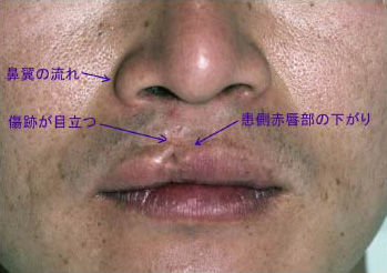 症例4　口唇裂術後修正手術 手術前