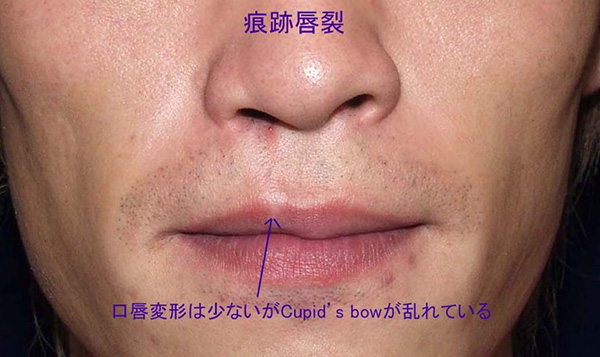 症例6　口唇裂術後（痕跡唇裂）修正手術 手術前