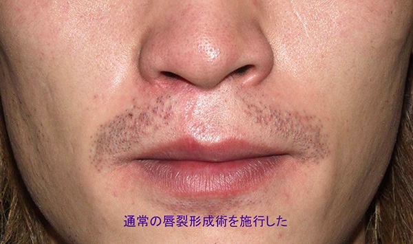 症例6　口唇裂術後（痕跡唇裂）修正手術 手術後
