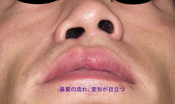 症例6　口唇裂術後（痕跡唇裂）修正手術 手術前