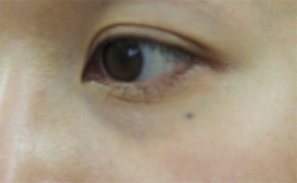 症例6　刺青（タトゥー）除去（レーザー） 治療前