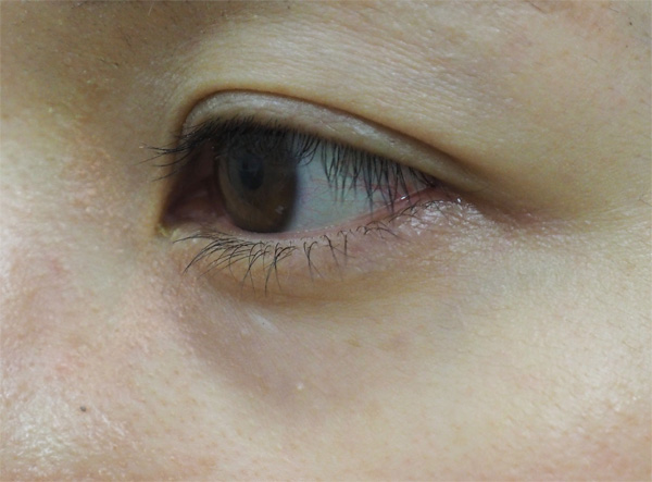 症例6　刺青（タトゥー）除去（レーザー） 治療後